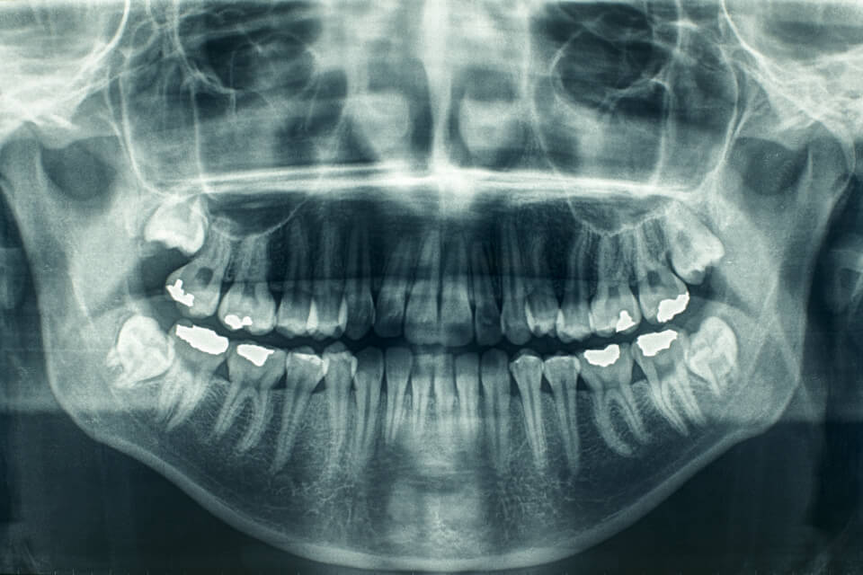 Digital X-Rays Digital X-Rays