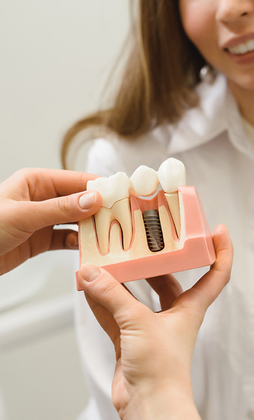 Dental Implants Model