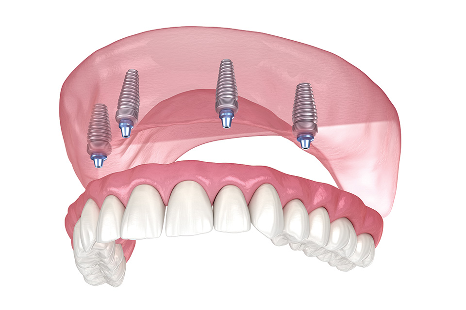 Full-arch Dental Implants