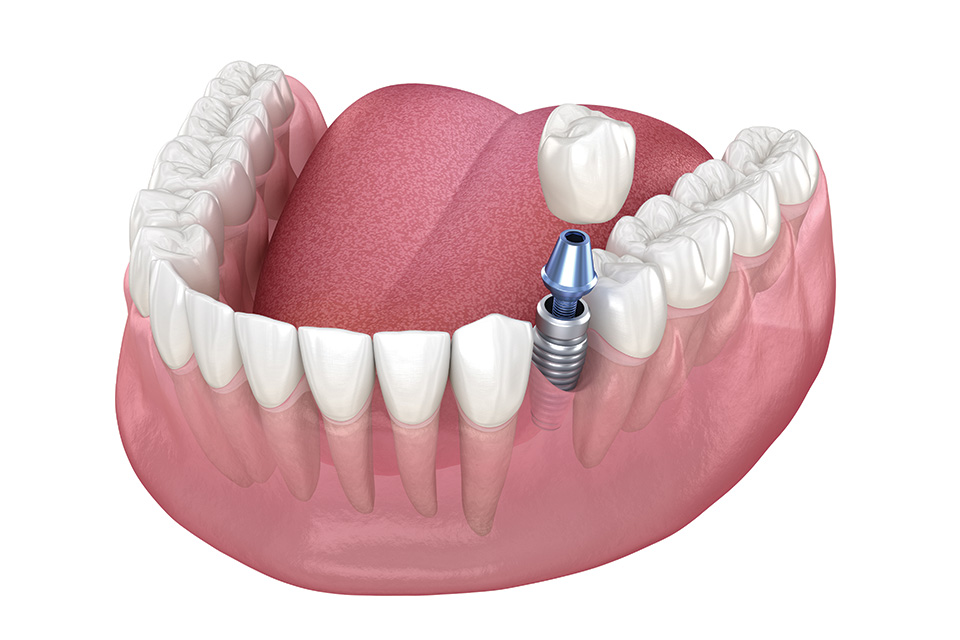 Single Dental Implants